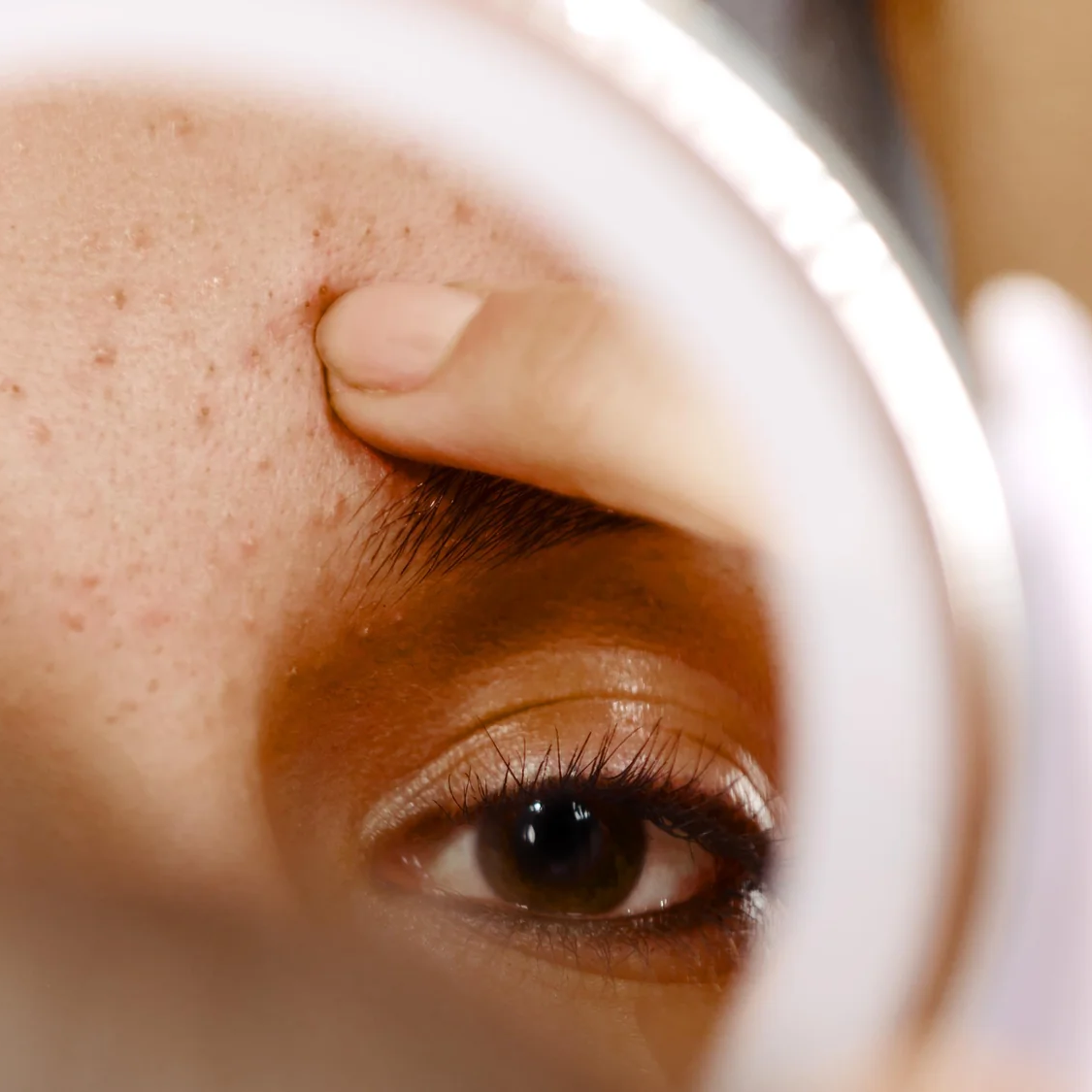 Why Shouldn't You Pop Pimples: 5 Reasons Not to Do It
